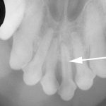 X-ray of discolored dog tooth